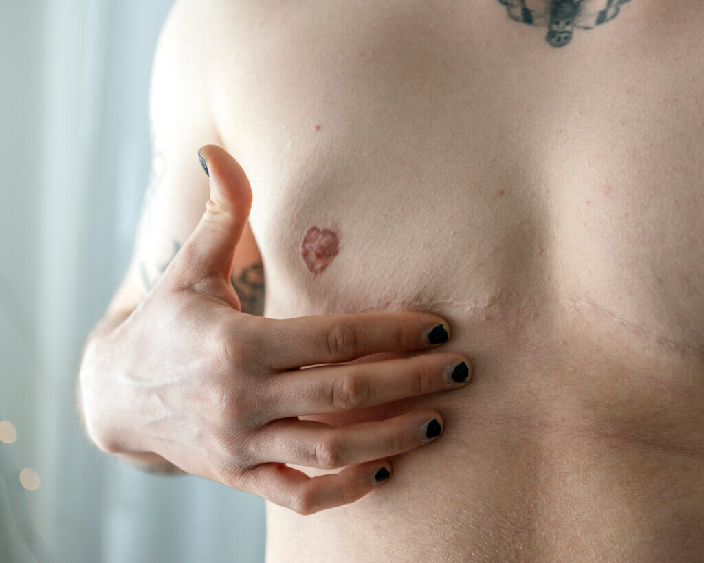 Henkilö koskettaa ylävartaloaan, jossa on arpia ja tatuointeja. Käsi lepää rinnalla, kynsilakka mustaa.